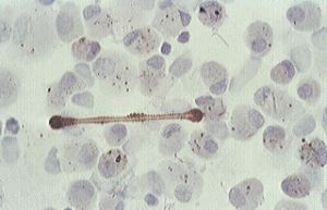 asbestos body surrounded by alveolar macrophages