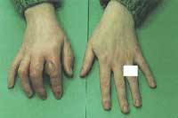 Image showing: 'Blistered hands.'